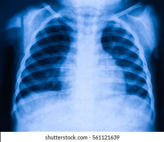 X Ray Of Lungs Ribs 