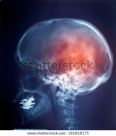 X ray MRI -  Image of Spinal Column Neck pain and Skull Head Stress 