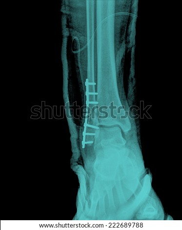 x ray painful ankle