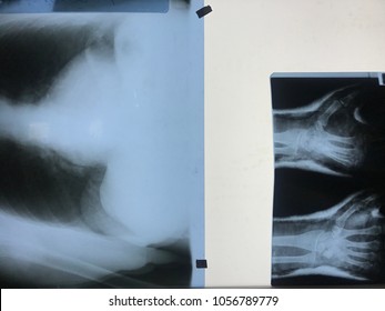 X Ray Pegged To A Light Box, Lungs And Hands Exposure