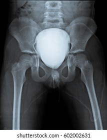 X Ray Of Pelvis With Distended Bladder.