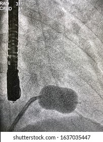 X Ray Of Percutaneous Transvenous Mitral Commissurotomy (PTMC) Or Percutaneous Mitral Balloon Valvotomy (PTMV) For Patient With Mitral Stenosis (MS).