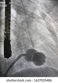 X Ray Of Percutaneous Transvenous Mitral Commissurotomy (PTMC) Or Percutaneous Mitral Balloon Valvotomy (PTMV) For Patient With Mitral Stenosis (MS).