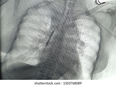 X Ray Was Performed Inflation Balloon Catheter In Artery And Bones