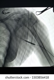 X Ray Was Performed Inflation Of Balloon Catheter And Bones In Operating Room