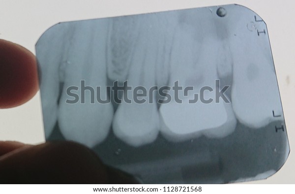 X Ray Periapical Abscess Molar Teeth Stock Photo (Edit Now) 1128721568