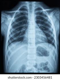 X ray photo image of chest area of young kid. X-ray lungs radiography 