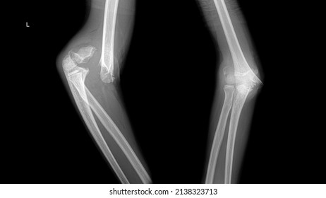X ray radiography of a child elbow with a humerus fracture.