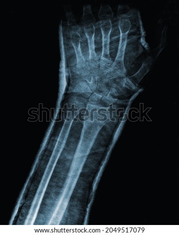 x ray radiography of the wrist hand and arm, showing healing of bone fracture