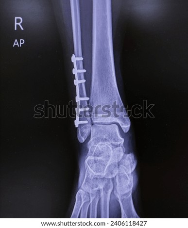 x - ray right ankle ap view fibula fracture post PAS fixation at distal fibula with good ligament,No prosthesis fracture.