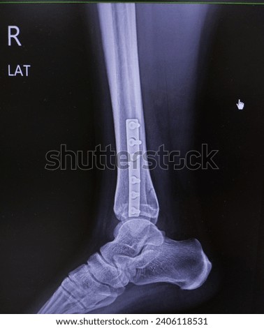 x - ray right ankle lateral view fibula fracture post PAS fixation at distal fibula with good ligament,No prosthesis fracture.
