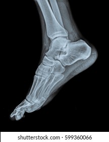 X Ray Of Right Foot