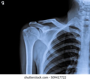 X Ray Of Shoulder Joint.