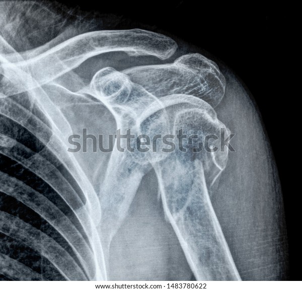 X Ray Shoulder Joint Injury Stock Photo (Edit Now) 1483780622