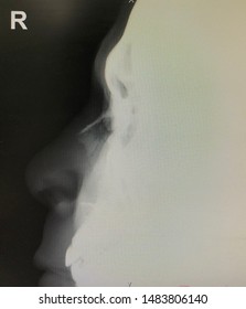 X Ray Showed Fracture Nasal Bone Stock Photo (Edit Now) 1483806140