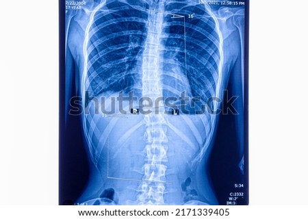 X ray showing scoliosis of the lumbar spine. Scoliosis is an abnormal lateral curvature of the spine. Zoom in.