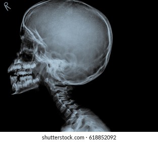 X Ray Of Skull Of Boy With Milk Teeth.