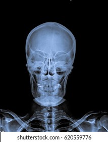 X Ray Of Skull Front View With Neck.