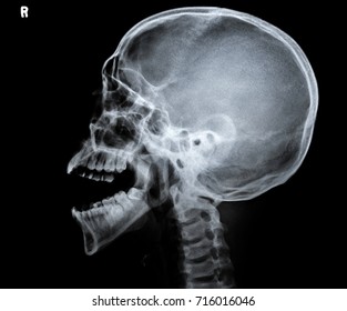 x ray of a skull side view.