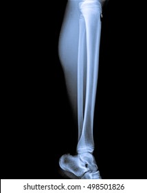 4,268 Tibia x ray Stock Photos, Images & Photography | Shutterstock