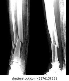 X ray Tibia Fibula Showing Fracture and dislocation.