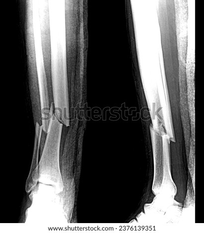 X ray Tibia Fibula Showing Fracture and dislocation.