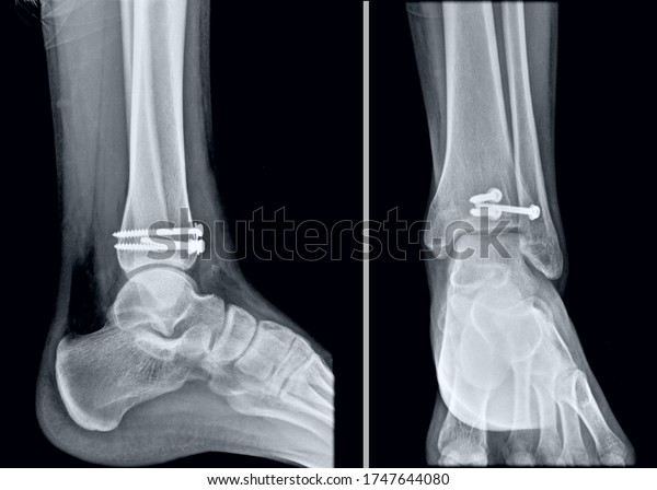 X Ray Tibia Fracture Fixation Nails Stock Photo 1747644080 