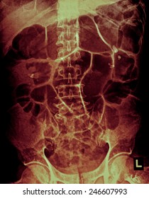 X-ray Of The Abdomen