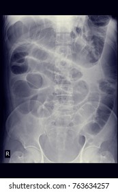 Xray Abdomen Series Show Colon Cancer