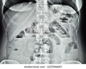 x-ray acute intestinal obstruction, intestinal arches - Shutterstock ID 2237046047