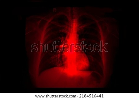 X-ray of adult female lungs, conditions after COVID-19, pandemic in Latin America, post-pandemic costs.