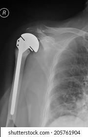 X-ray After Artificial Shoulder Joint Replacement Surgery