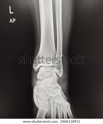 X-ray  Ankle A female accident showing Spiral fracture of distal fibula at level of syndesmosis, with minimal displacement on red arrow mark. Medical image concept.