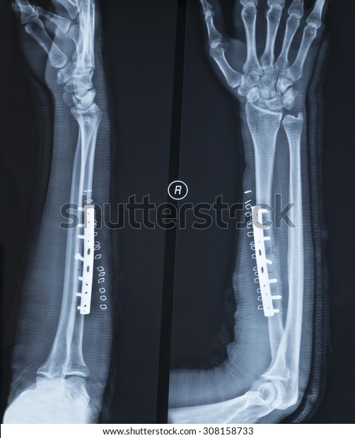 Xray Arm Bone Connecting Right Arm Stock Photo Edit Now 308158733