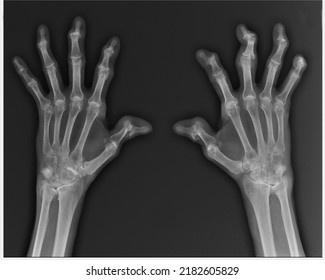 x-ray arthritis of the bones of the hands and feet - Shutterstock ID 2182605829