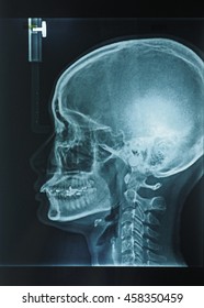 X-ray Asian Skull And Blank Area At Left Side, Overbite Teeth