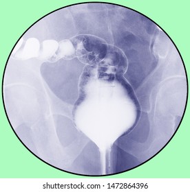 X-ray Barium Enema Examination (lower Gastrointestinal (GI))