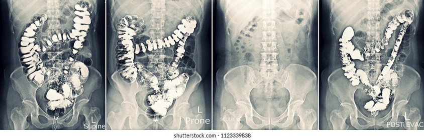 X-ray Barium Enema (Lower GI Examination)