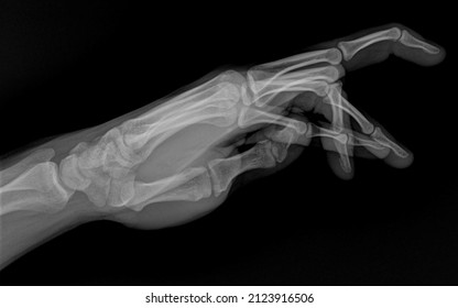 Xray Of Bent Of Human Hand Fingers Side View. X-ray Of Male Hand And Wrist. X Ray Of Healthy Whole Bones Of The Hand Close-up. 