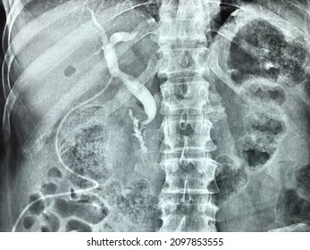 X-ray Of The Bile Ducts
