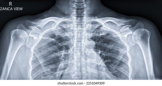 X-ray of both Clavicle Zanca view for diagnosis fracture of Clavicle . - Shutterstock ID 2251049309