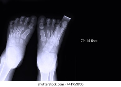 Xray Both Foot : Child Foot : Show Fracture At Big Toe 