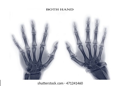 xray both hand  - Shutterstock ID 471241460