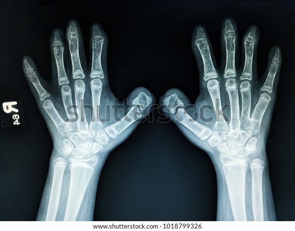 Xray Both Hands Abnormal Thumb Absent Stock Photo (Edit Now) 1018799326