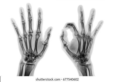 X-ray both hands with OK sign - Shutterstock ID 677540602