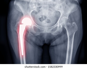 X-ray Both Hip  Ap View Showing Right Hip Replacement Or Hip Prosthesis Made From Titanium.