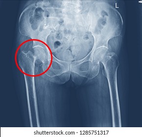 Xray Both Hip Fracture Right Neck Stock Photo 1285751317 | Shutterstock