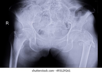 hip xray normal vs fracture