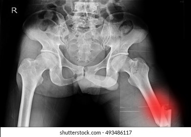 Xray Both Hip Show Closed Fracture Femur Left