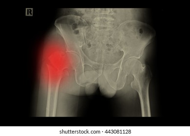 Xray Both Hip Show Fracture Right 